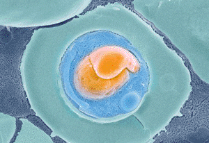 Image: Colored scanning electron micrograph (SEM) of a freeze-fractured red blood cell (erythrocyte, green) infected with a Plasmodium falciparum protozoan (orange and blue) (Photo courtesy of the NIBSC). Image: Colored scanning electron micrograph (SEM) of a freeze-fractured red blood cell (erythrocyte, green) infected with a Plasmodium falciparum protozoan (orange and blue) (Photo courtesy of the NIBSC).
